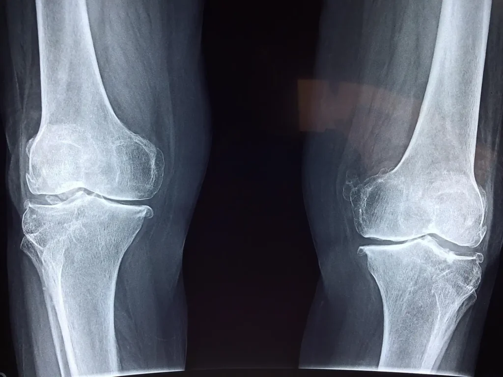 Radiographie de face de deux genoux, os blancs du fémur et du tibia sur fond sombre