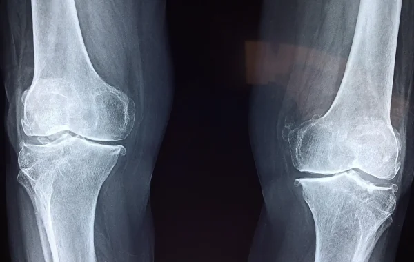 Radiographie de face de deux genoux, os blancs du fémur et du tibia sur fond sombre